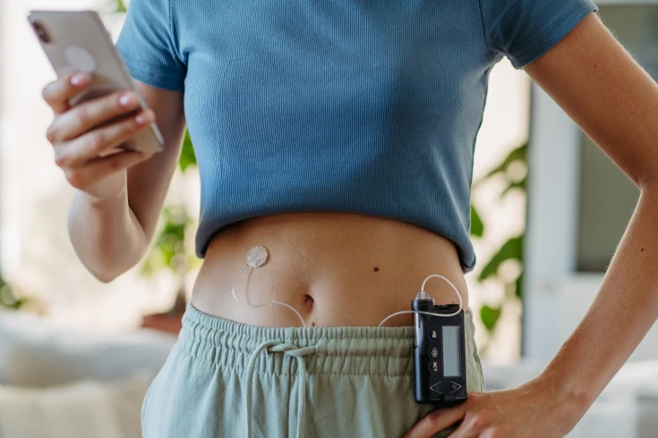 A person wears their insulin pump for regular insulin delivery