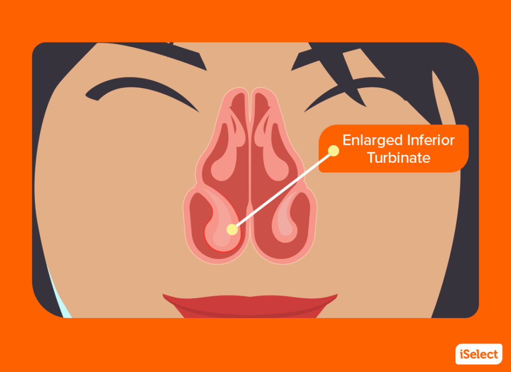 Illustration of an enlarged inferior turbinate throughout the nasal cavity